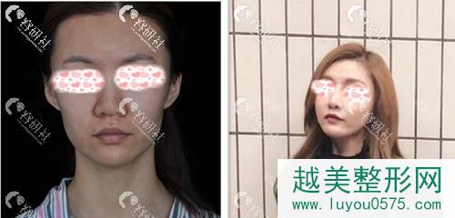 俊泰丽格医疗美容（鼻修复中心）薛志强鼻部手术案例