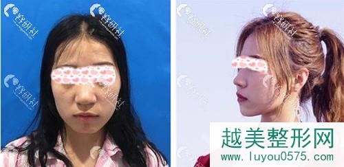 深圳美莱医疗美容医院梁晓健鼻部手术案例