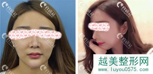 深圳雅涵医疗美容门诊部高山鼻部手术对比图