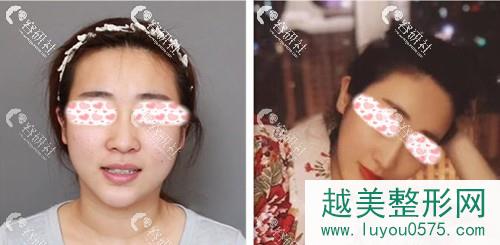 北京米扬丽格医疗美容巫文云鼻部手术案例