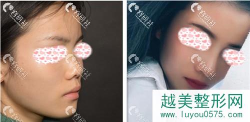 北京柏丽医疗美容门诊部李劲良鼻部手术前后对比图