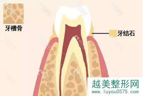 牙槽骨对牙齿的影响