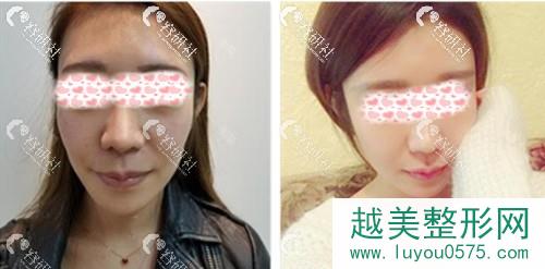 北京清木医疗美容诊所马梅生脸部自体脂肪填充案例