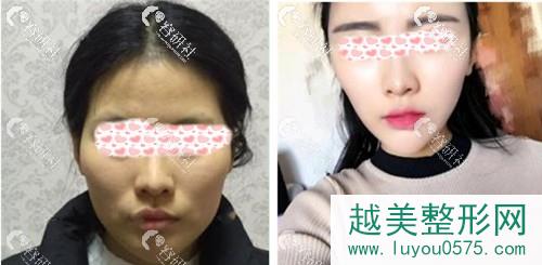 北京新星靓医疗美容医院脸部自体脂肪填充案例