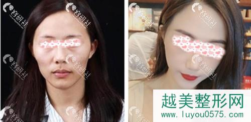 北京新星靓医疗美容医院李伟民院长脸部自体脂肪填充前后对比照