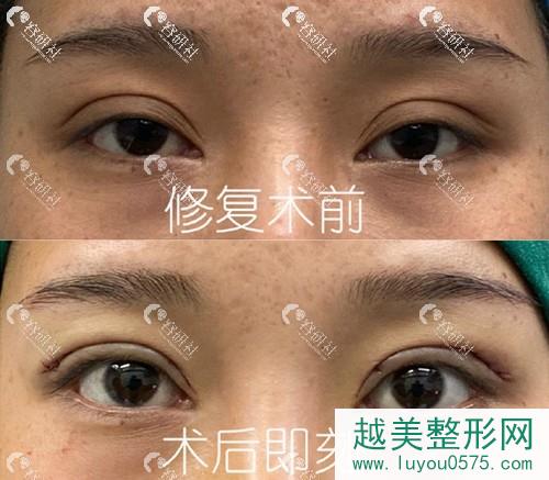 杭州格莱美医疗美容医院双眼皮修复手术案例