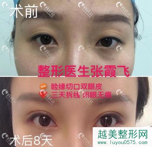 杭州格莱美医疗美容医院双眼皮术前术后对比