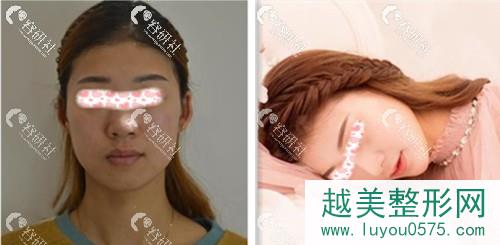 南京艺星医疗美容辛海龙玻尿酸填充全脸案例