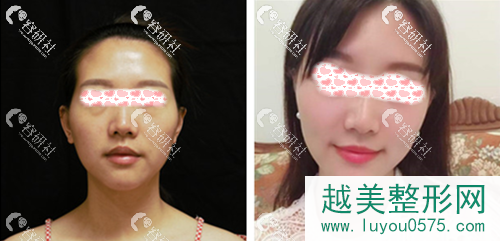 深圳美莱医疗美容医院黄海龙玻尿酸丰太阳穴案例