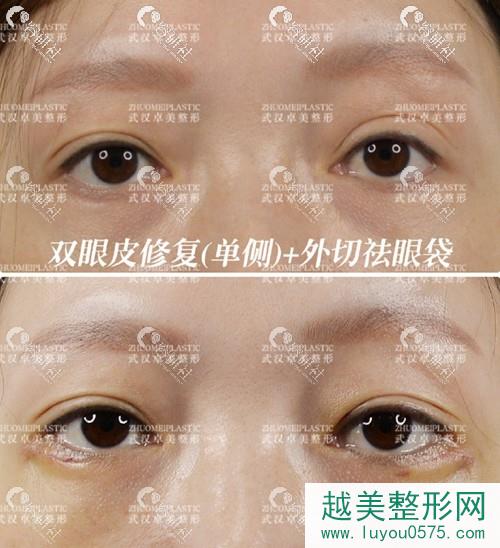 武汉硚口卓美医疗美容门诊部双眼皮修复案例