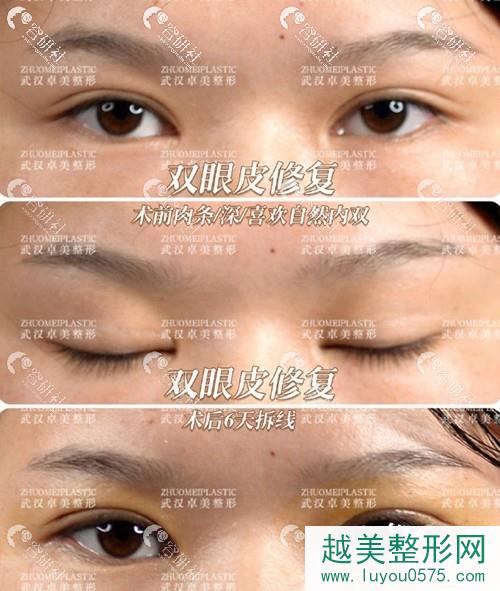 武汉硚口卓美医疗美容门诊部双眼皮修复术后恢复过程