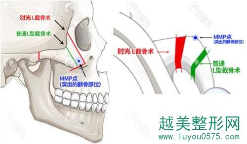上海时光整形外科医院L截骨与普通截骨有何不同