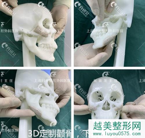 上海时光3D定制颧骨、下颌角修复体
