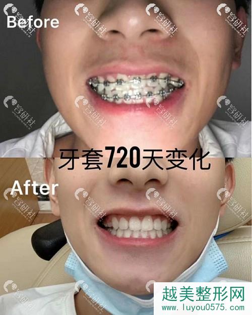 广州地区牙齿矫正术后果照片分享