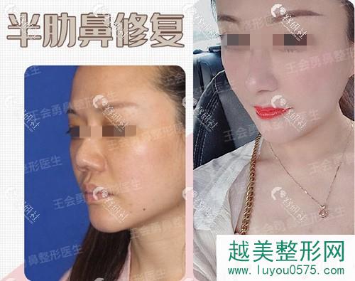 上海喜美王会勇半肋鼻修复术前术后对比照