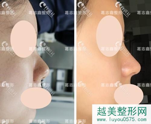 上海知颜医疗美容门诊部隆鼻术前术后对比