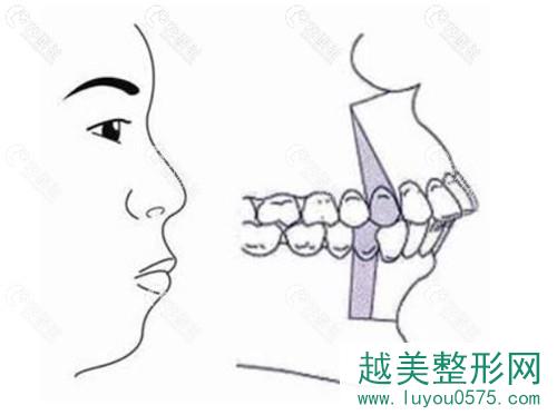 骨性和牙性凸嘴的区别