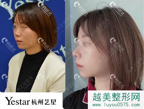 杭州艺星张龙隆鼻术前术后对比