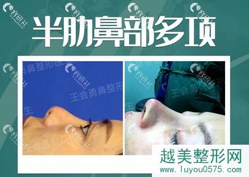 上海喜美医疗王会勇半肋骨鼻部手术术后案例