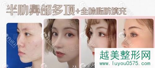 上海喜美医疗王会勇半肋骨鼻部手术案例对比