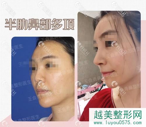 上海喜美医疗王会勇半肋骨鼻部手术对比案例刻案例