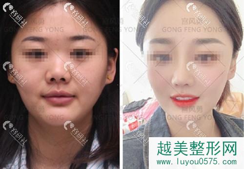 北京新星靓宫风勇隆鼻术前术后对比照