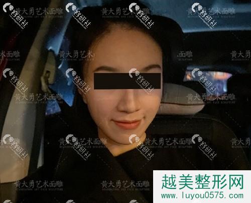 北京圣嘉荣医疗美容医院黄大勇下颌角磨骨手术术后