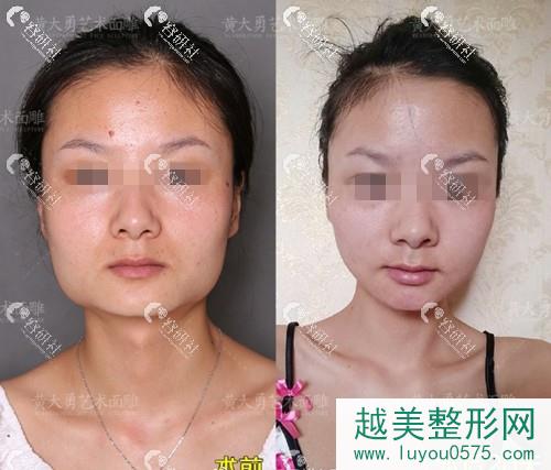 北京圣嘉荣医疗美容医院下颌角手术案例