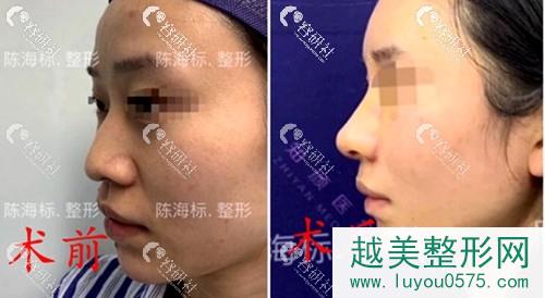 上海知颜陈海标医生肋骨隆鼻术前术后对比