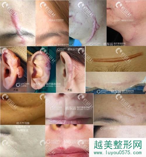 重庆杨东运医生部分疤痕修复案例