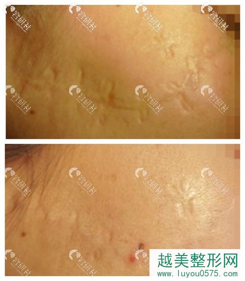 杨东运医生面部缝合疤痕修复果照片