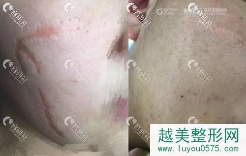 杨东运医生面部伤口疤痕修复果照片