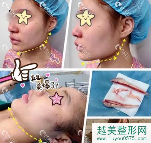 上海金一秀下颌角磨骨手术案例照片