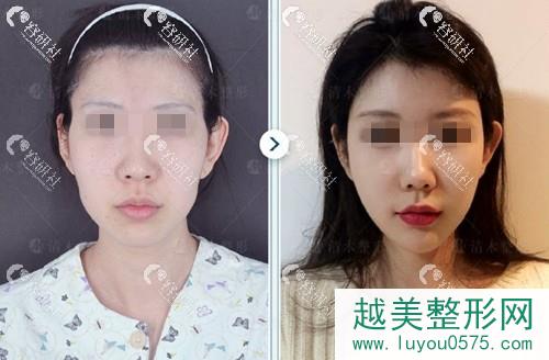 北京清木马梅生面部脂肪填充术前术后对比照