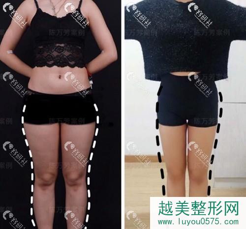 北京联合丽格陈万芳吸脂术前术后对比照