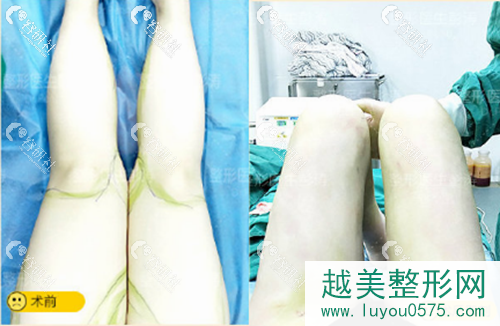 杭州格莱美彭涛医生大腿吸脂术前术后对比照