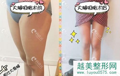 北京薇琳桑建波大腿吸脂案例