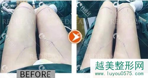 北京薇琳桑建波大腿吸脂术前术后对比照