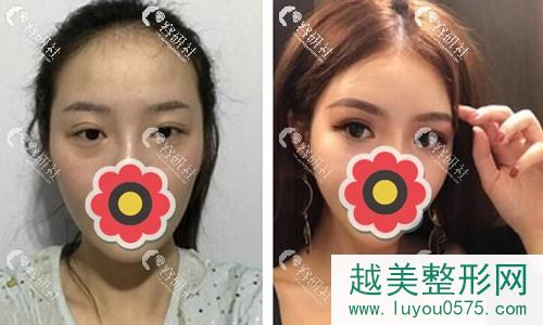 广州南方医院冯传波双眼皮修复案例
