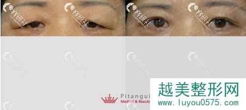 韩国Pitangui必当归整形外科双眼皮去脂+提肌改善案例