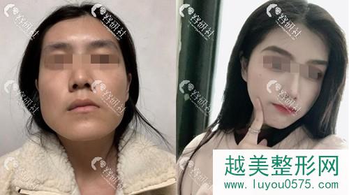 上海仁爱刘先超医生下颌角手术术前术后对比照