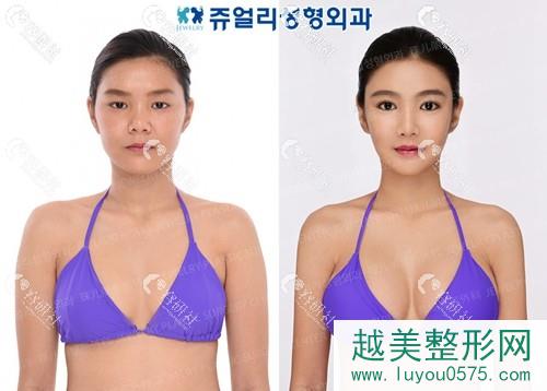 韩国珠儿丽整形医院隆胸术前术后对比照