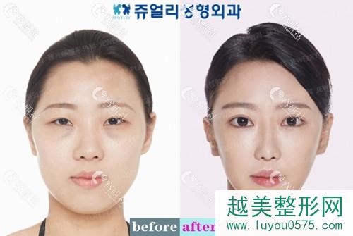 韩国珠儿丽整形外科医院鼻部手术整形案例