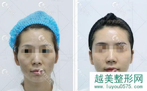 北京东方和谐医疗美容冯斌面部脂肪填充前后对比