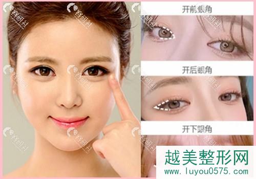 韩国珠儿丽立体开眼角手术包含三个部位