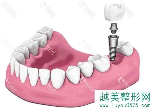 种植牙手术原理揭示