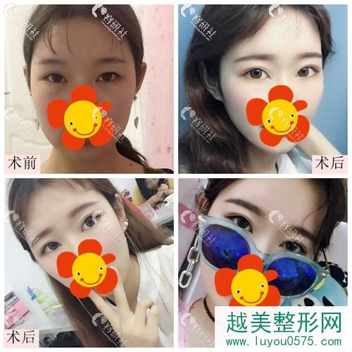 广州韩后整形医院双眼皮修复案例