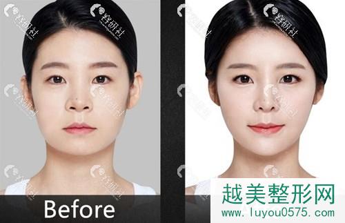 妹子在韩国必当归做下颌角截骨+眼鼻整形术前术后对比图