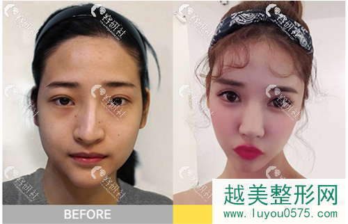 韩国珠儿丽整形外科医院下颌角整形案例前后对比图