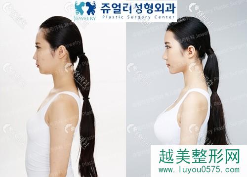 韩国珠儿丽做假体隆胸案例